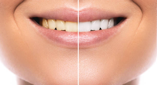 5 Proven Ways to Whiten Yellow Teeth Naturally at Home