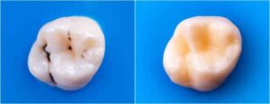 Oil Pulling with Coconut Oil: 6 Proven Benefits for Teeth & Gums