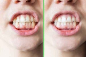 Oil Pulling with Coconut Oil: 6 Proven Benefits for Teeth & Gums