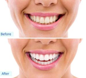 Natural progression from yellow to white teeth using safe at-home whitening methods