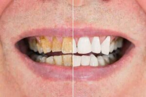 Oil Pulling with Coconut Oil: 6 Proven Benefits for Teeth & Gums 