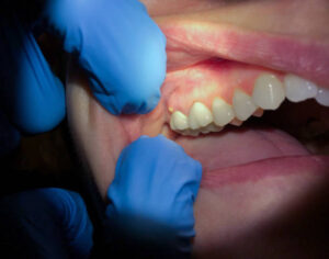What is the Fastest Way to Heal Swollen Gums? (10 Emergency Remedies That Work!)