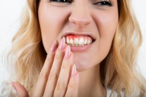 What is the Fastest Way to Heal Swollen Gums? (10 Emergency Remedies That Work!)