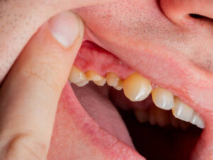 Home Treatment for Swollen Gums