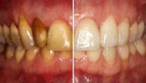 Natural cavity reversal results after 30 days using remineralizing foods