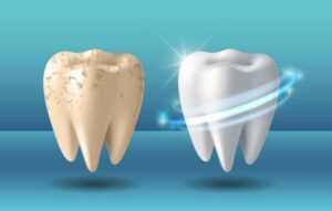 White spot lesions before and after hydroxyapatite toothpaste treatment - 48-hour enamel repair results