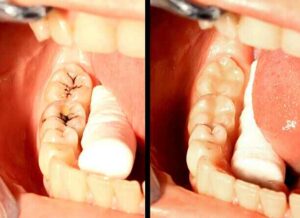reverse cavities naturally without drilling