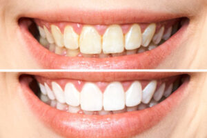 oil pulling before and after results