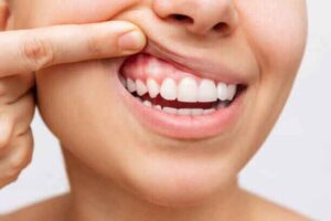 healthy, pink gums after oil pulling