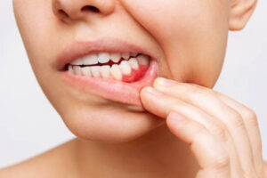 receding gums