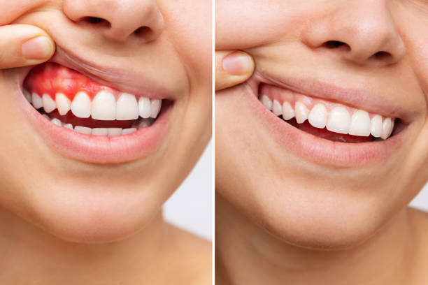 reverse receding gums naturally before and after