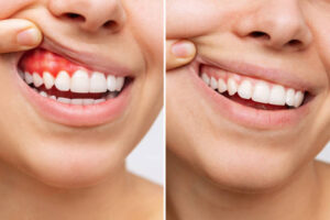 before and after result of gums and teeth