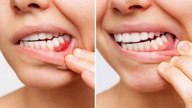 receding gums before vs after results