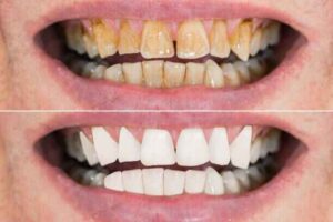 Reduction in Surface Stains after oil pulling 
