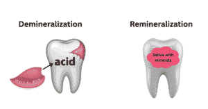 How demineralization and remineralization work to heal cavities with food