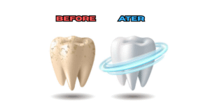 Conceptual before and after visualization of tooth enamel repair with consistent use of nano-hydroxyapatite toothpaste.