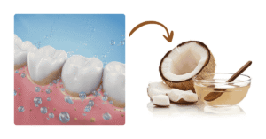 coconut oil remove plaque 