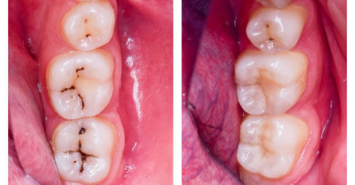 heal cavities with food