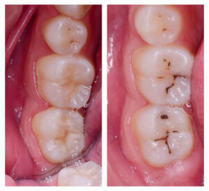 Early cavity vs severe decay - when you can still heal cavities with food