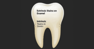 Diagram showing the difference between surface stains and deep tooth discoloration.