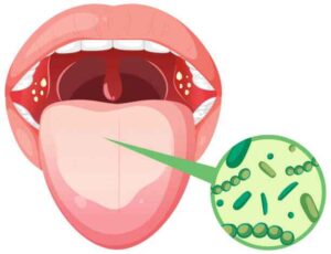 diagram-of-sulfur-producing-bacteria-on-tongue-causing-bad-breath