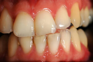 visual signs of weak enamel like sensitivity and discoloration