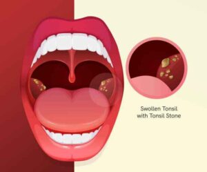 Visual guide identifying tonsil stones on the tonsils as a cause of bad breath