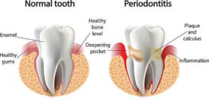 Diagram of healthy gums versus gum disease pockets causing bad breath