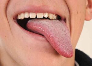 Close-up of bacterial coating on the back of the tongue causing odor