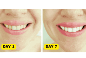 7-day natural teeth whitening challenge results: before and after photos showing visible stain removal.