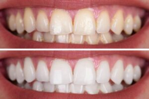 Realistic coconut oil whiten teeth before and after timeline showing gradual surface stain reduction