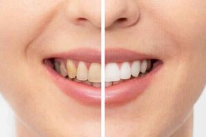 Natural teeth whitening before and after results using the 7-day kitchen cabinet method