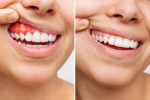 reverse gums naturally 