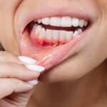reverse gum disease naturally