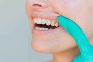 reverse gum disease naturally