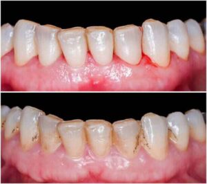 gum disease before after