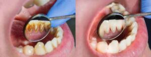 Close-up visual comparison: fuzzy plaque buildup on teeth vs. smooth, clean teeth after following a natural 7-day protocol to remove teeth plaque naturally.