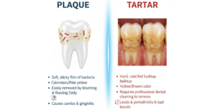 Plaque vs. Tartar