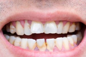 Plaque Buildup on Teeth