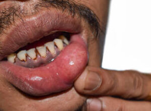 Periodontal Bone Loss & Tooth Mobility