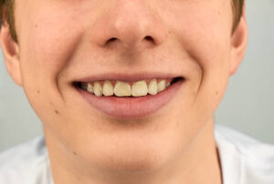 Tooth Discoloration