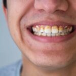 natural plaque removal on teeth