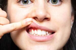 Stop Bleeding Gums