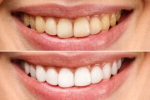 yellow teeth vs white teeth