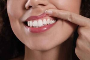 herbal remedies for healthy gums include turmeric, neem powder with clove oil or aloe vera