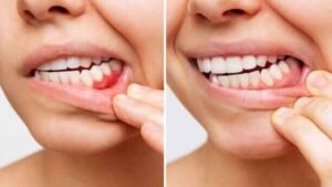 How Herbs Protect gums from disease