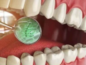 What Causes Bad Breath Germs?
