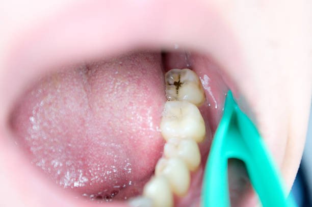 دانتوں میں کیڑا لگنے (Tooth Cavity) اور ڈاڑھ کی کیویٹی کا قدرتی علاج