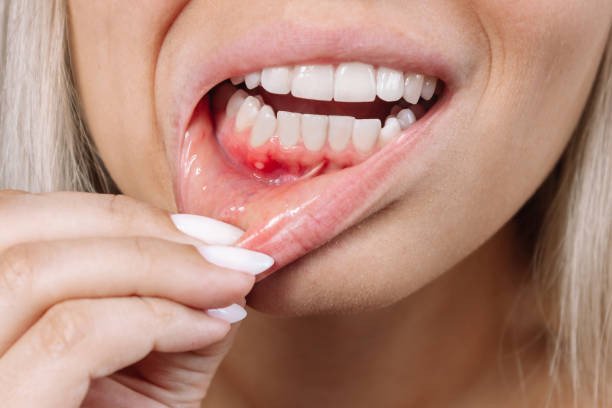 مسوڑھوں سے خون آنے اور سوجن (Bleeding Gums) کا قدرتی علاج
