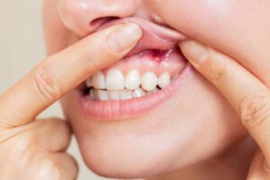 مسوڑھوں کی سوجن، داغ اور ورم کا قدرتی علاج